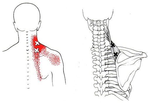 نقاط ماشه‌ای عضله بالابرنده کتف (Levator Scapulae)